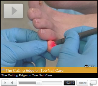 Laser Treatment for Fungal Toenails WATCH - As seen on Good Morning America