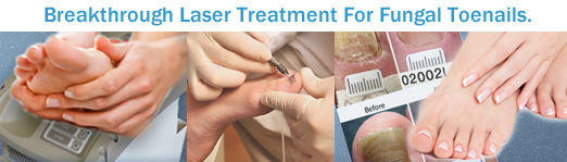 Collage of Breakthrough Laser Treatment for Fungal Toenails