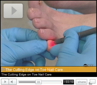 Laser Treatment for Fungal Toenails