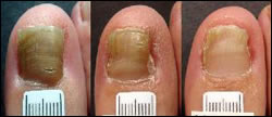 Toenail fungus treatment results